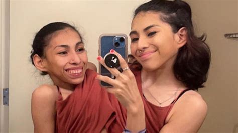 conjoined twins on tiktok|jay already famous conjoined twins.